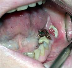 Cancer in cats occurs in different areas of the body and may include certain organs, lymph nodes and bones. Mitigating Osteonecrosis Of The Jaw Onj Through Preventive Dental Care And Understanding Of Risk Factors Bone Research