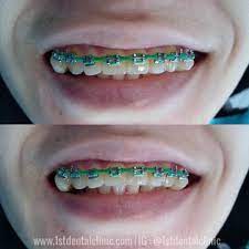 When teens make their own braces, the material from the. The Dangers Of Fake Braces 1st Dental Clinic