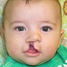 NAM Appliances for Cleft Palate