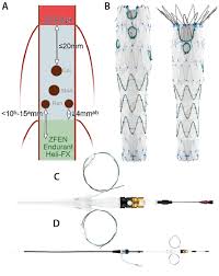 Dumon, however, introduced the first completely endoluminal airway stent in. Modern Complex Stent Graft Designs A Closer Look Endovascular Today