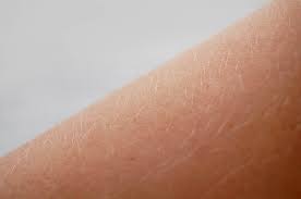 Does Laser Hair Removal Work On Blonde Hair Skinfx Canada