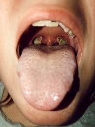 Image result for Tonsillectomy