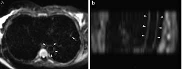 .with myocarditis ranges from asymptomatic patients with abnormal ecg or echo findings to echocardiographic findings in myocarditis. Feasibility Of Cardiac Diffusion Weighted Mr Imaging In Acute Myocarditis A Pilot Study
