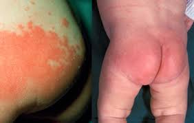 Image result for newborn diaper rash