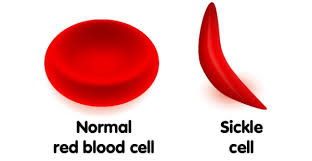 The most common type is known as sickle cell anaemia (sca). Sickle Cell Anemia Sickle Cell Anemia Treatment Cost In India Medsurgeindia