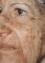 Guten tag, pigmentverschiebung nach fruchtsäurepeeling sind recht selten. Hautarzt Lasertherapie Dermatologie Medizinische Kosmetik Hautarzt Nuernberg De