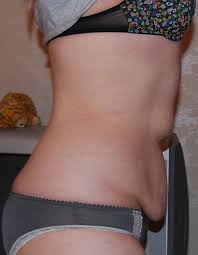 Pin On Gastric Bypass