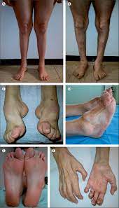 Diagnosis Natural History And Management Of Charcot Marie Tooth Disease The Lancet Neurology