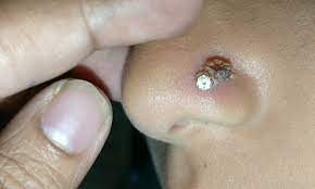 10 Tips To Treat An Infected Nose Piercing