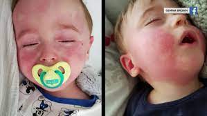 Professor paul hunter, an infectious disease expert at the university of east anglia. At Least 85 Kids Across U S Have Developed Rare Mysterious Covid 19 Linked Illness