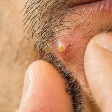 How To Get Rid Of Boils Causes Symptoms Prevention Treatment Pictures (archaic) a meteor or brilliant shooting star, followed by a train of light or sparks; get rid of boils causes symptoms