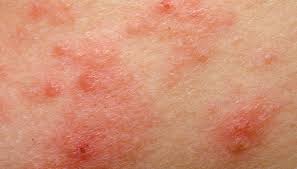 Prima di vedere come si cura lo staffilococco, ecco alcune nozioni di base. Eczema 7 Pazienti Su 10 Sono Invasi Dal Batterio Stafilococco Dilei