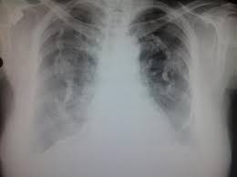 The ginkgo leaf sign (of subcutaneous emphysema) is a radiographic appearance identified with severe subcutaneous emphysema of the chest wall. Holly Leaf Sign Radiology Reference Article Radiopaedia Org