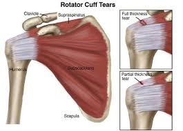 Image result for Rotator Cuff Injury