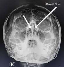 Image result for Sinus X Ray