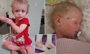 Three-year-old Qld girl is allergic to almost everything