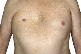 Poland syndrome is a congenital abnormality that causes agenesis of pectoralis muscle on one side. Poland Syndrome Stock Image C047 5936 Science Photo Library