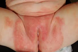 Image result for diaper dermatitis