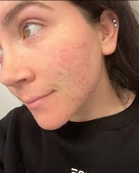 Yup.. I've struggled with acne too. I've been overweight. I've had acne for  years and would not leave to go anywhere without foundation caked