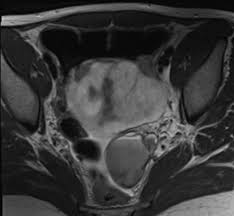 Jan hein van waesberghe, marieke hazewinkel and milou busard. Endometriosis Radiology Features And Differtial Diagnosis