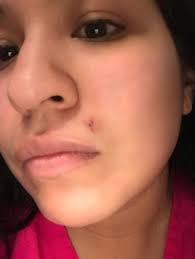 Old Lip Piercing Scar Removal Austin Tx Review Realself