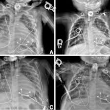 It is the name given to the impaired functioning of the lubricating pleural fluid. Chest X Ray Images Of Pleural Effusions A Bilateral Pleural Effusions Download Scientific Diagram
