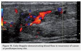 Ca 27.29 is one of several antigens that doctors use as tumor markers for breast cancer. Color Doppler Sonography Characterizing Breast Lesions