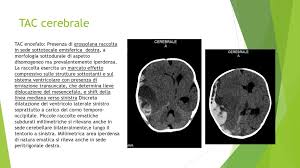 La conferma diagnostica richiede, tuttavia, la «fotografia» dell'emorragia cerebrale. Un Emorragia Cerebrale Su Base Genetica Ppt Scaricare