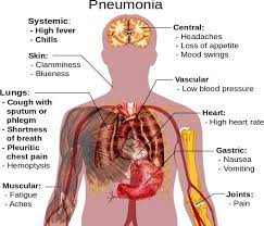 Maybe you would like to learn more about one of these? Pneumonia Causes Symptoms Treatment Diagnosis And Prevention Galleria Community Health And Lifestyle Nigeria