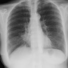 To diagnose a bruised rib or rib fracture, a doctor will take detailed notes about the injury and the aftermath, including the person's symptoms. Lobar Lung Collapse Radiology Reference Article Radiopaedia Org