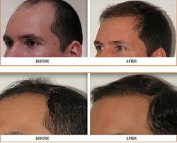 Biotin improves hair growth and helps with inflammation, she says. Demystifying Hair Loss Treatment Jan 2013 Townsend Letter For Doctors Patients