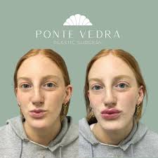 Plump your pout 👄 at PVPS 💉Treatment: Lip Filler 👩🏼‍⚕️Provider:  @pvpscarrie 🤍Product: Restylane Kysse 1ml Call 📲 (904) 273-6200 with your  questions