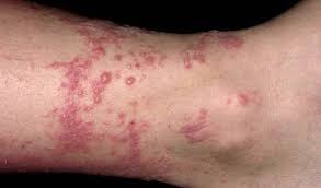 How To Get Rid Of Poison Ivy Rashes Fast Poison Ivy Rash Poison Ivy Remedies Poison Ivy On Skin