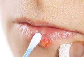 Its structure is composed of linear dsdna, an icosahedral capsid that is 100 to 110 nm in diameter, with a spikey envelope. Cold Sores Online Treatment Herpes Simplex 1 Treatment Herp Alert
