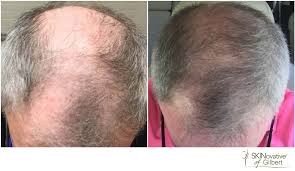 There are a lot of treatments out there that target male pattern baldness. Non Surgical Hair Loss Therapy In Gilbert Az Gilbert Med Spa Serving Mesa Chandler Tempe