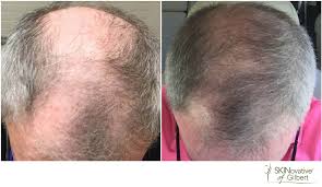 It involves pricking the skin with tiny sterilized needles. Non Surgical Hair Loss Therapy In Gilbert Az Gilbert Med Spa Serving Mesa Chandler Tempe