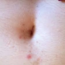 There are also best creams for removing ingrown the difficulty of the process on how to remove ingrown hair will depend on a number of things. How To Get Rid Of Red And Brown Ingrown Hair Scars Underneath Belly Button Due To Shaving And Picking Photos