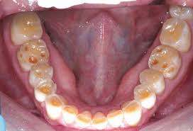 Image result for Tooth Attrition