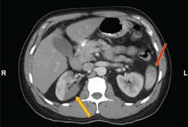 Image result for Renal Infarction