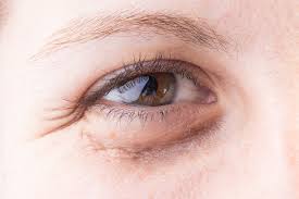 9 Causes Of Dark Eye Circles Take Action To Reduce Dark Circles Under Eyes With Natural Noninvasive Methods Blissoma Botanical Beauty