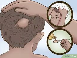There are similar autoimmune conditions, called alopecia totalis and alopecia universalis, in which hair loss is more extensive. How To Stop Hair Loss In Children With Pictures Wikihow
