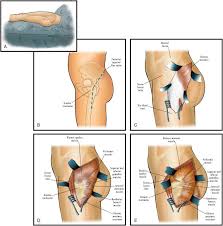 With that said, so long as you're careful and following the diagram and video shown on this page. Kocher Langenbeck Approach A Right Lateral Decubitus Position B Download Scientific Diagram