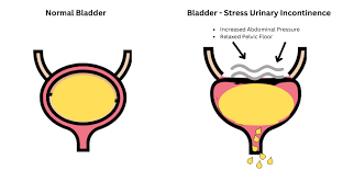 Image result for Stress Incontinence
