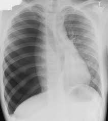 Pneumothoraces) refers to the presence of gas (often air) in the pleural space. Tension Pneumothorax In Asthma Resuscitation