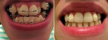 How should i brush with braces? Things To Do When Experiencing Mouth Ulcer While Wearing Braces Orthodontist Southington Ct Team Demas Orthodontics