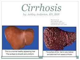We did not find results for: Cirrhosis By Ashley Anderton Rn Bsn Ppt Video Online Download