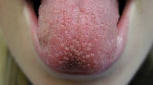 If experienced, these tend to have a less severe expression i. Tongue Bumps Causes When To See A Doctor And Treatment