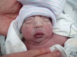 Faith and Sarah, twins discordant for anencephaly