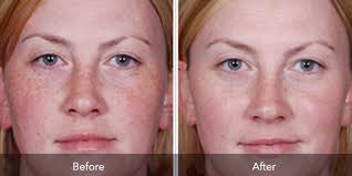 Flawless Body Skin Body Laser Aesthetics