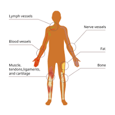 Image result for Sarcoma